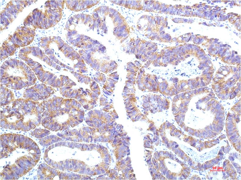 Immunohistochemical analysis of paraffin-embedded Human Colon Carrcinoma Tissue using STAT1 (EM1259) Mouse mAb diluted at 1:200.