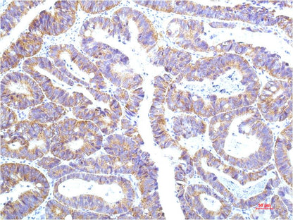 Immunohistochemical analysis of paraffin-embedded Human Colon Carrcinoma Tissue using STAT1 (EM1259) Mouse mAb diluted at 1:200.