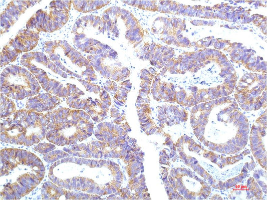 Immunohistochemical analysis of paraffin-embedded Human Colon Carrcinoma Tissue using STAT1 (EM1259) Mouse mAb diluted at 1:200.