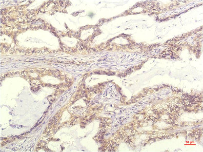 Immunohistochemical analysis of paraffin-embedded Human Lung Carrcinoma Tissue using IL-8 (EM1260) Mouse mAb diluted at 1:200.