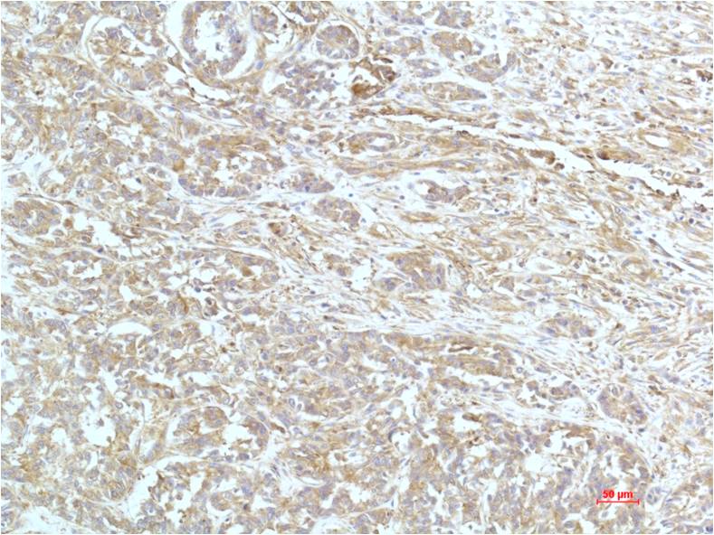 Immunohistochemical analysis of paraffin-embedded Human Breast Carrcinoma Tissue using a-actinin (EM1261) Mouse mAb diluted at 1:200.