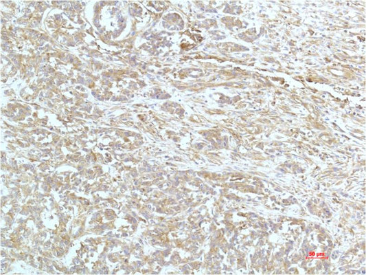 Immunohistochemical analysis of paraffin-embedded Human Breast Carrcinoma Tissue using a-actinin (EM1261) Mouse mAb diluted at 1:200.