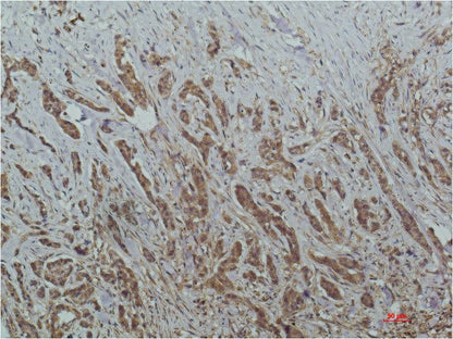 Immunohistochemical analysis of paraffin-embedded Human Breast Carcinoma Tissue using HADC1 (EM1265) Mouse mAb diluted at 1:200.