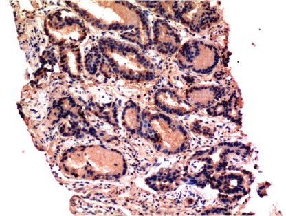 Immunohistochemical analysis of paraffin-embedded Human Prostate Tissue using Caspase-3 (EM1266) Mouse mAb diluted at 1:200.