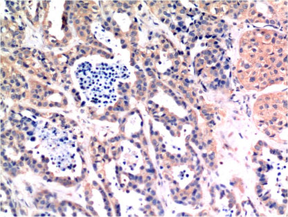 Immunohistochemical analysis of paraffin-embedded Human Breast Carcinoma Tissue using Bax (EM1268) Mouse mAb diluted at 1:200.