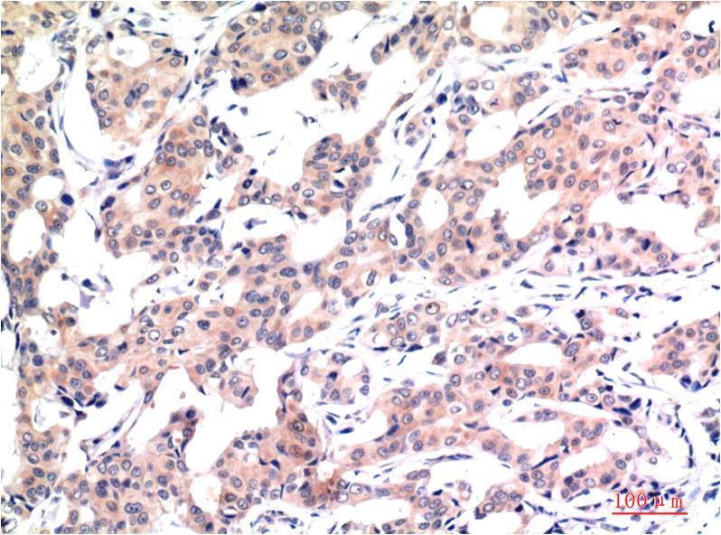 Immunohistochemical analysis of paraffin-embedded Human Breast Carcinoma Tissue using Acetyl Histone H3 K9 (EM1292) Mouse mAb diluted at 1:200.