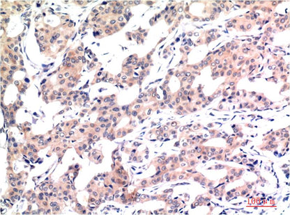 Immunohistochemical analysis of paraffin-embedded Human Breast Carcinoma Tissue using Acetyl Histone H3 K9 (EM1292) Mouse mAb diluted at 1:200.