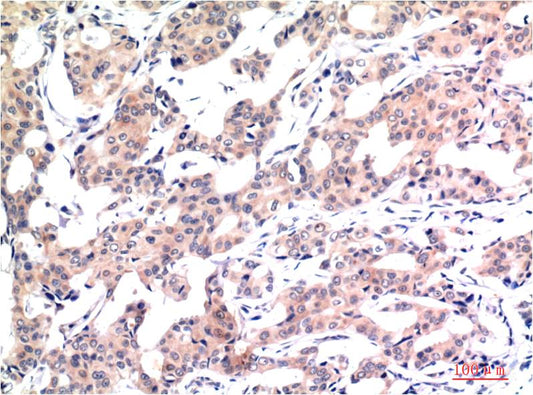 Immunohistochemical analysis of paraffin-embedded Human Breast Carcinoma Tissue using Acetyl Histone H3 K9 (EM1292) Mouse mAb diluted at 1:200.