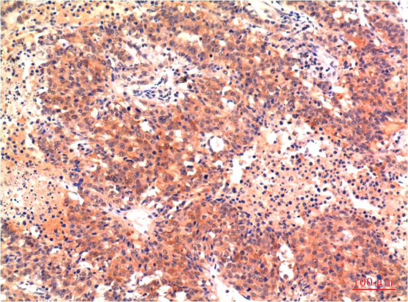 Immunohistochemical analysis of paraffin-embedded Human Heptacarcinoma Tissue using LC3A (EM1298) Mouse mAb diluted at 1:200.