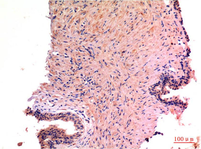 Immunohistochemical analysis of paraffin-embedded Human Prostate Carcinoma Tissue using LC3A (EM1298 ) Mouse mAb diluted at 1:200.