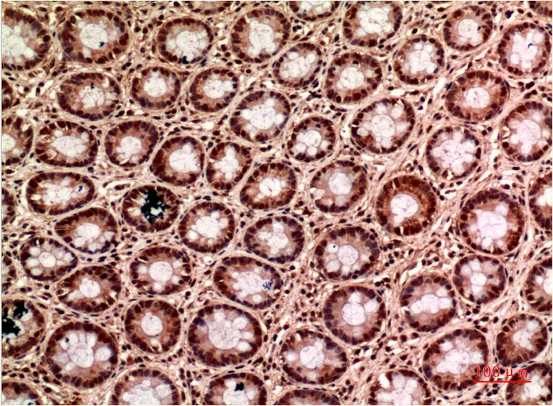 Immunohistochemical analysis of paraffin-embedded Human Colon Carcinoma Tissue using Gamma Tubulin (EM1302) Mouse mAb diluted at 1:200.