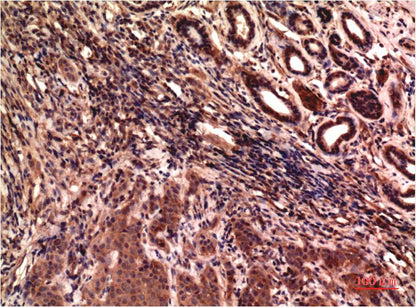 Immunohistochemical analysis of paraffin-embedded Human Breast Carcinoma Tissue using Gamma Tubulin ( EM1302 ) Mouse mAb diluted at 1:200.