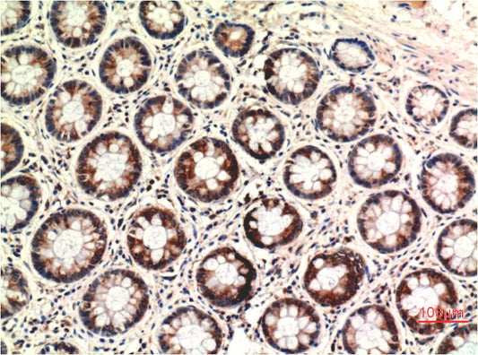 Immunohistochemical analysis of paraffin-embedded Human Colon Carcinoma Tissue using PTEN (EM1308) Mouse mAb diluted at 1:200.