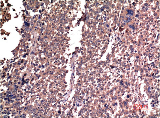Immunohistochemical analysis of paraffin-embedded Human Lung Carcinoma Tissue using Cyclin B1 (EM1310) Mouse mAb diluted at 1:200.