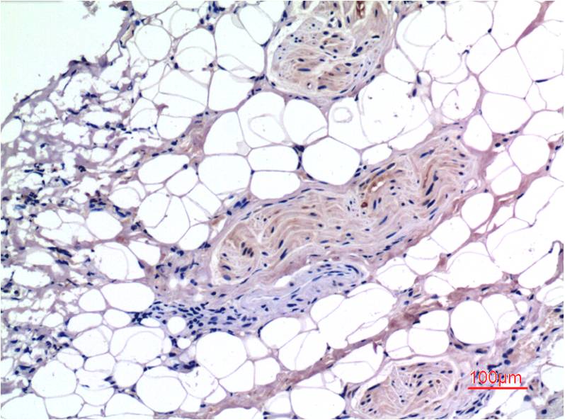 Immunohistochemical analysis of paraffin-embedded Human Liver Carcinoma Tissue using Smad3 (EM1315) Mouse mAb diluted at 1:200.