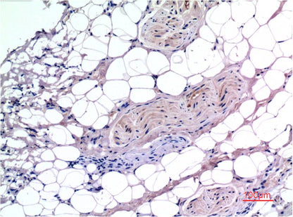 Immunohistochemical analysis of paraffin-embedded Human Liver Carcinoma Tissue using Smad3 (EM1315) Mouse mAb diluted at 1:200.