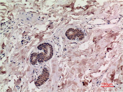 Immunohistochemical analysis of paraffin-embedded Human Breast Carcinoma Tissue using Smad3 (EM1315) Mouse mAb diluted at 1:200.