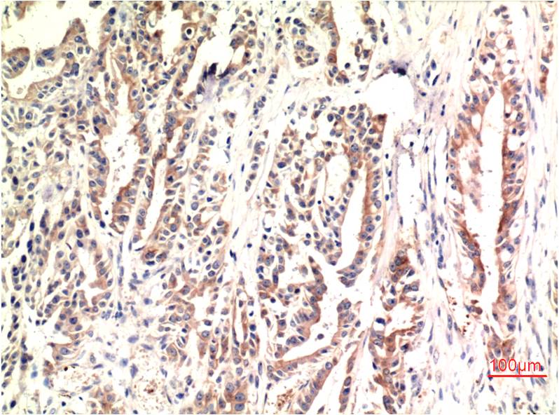 Immunohistochemical analysis of paraffin-embedded Human Stomach Carcinoma Tissue using CHOP (EM1317) Mouse mAb diluted at 1:200.