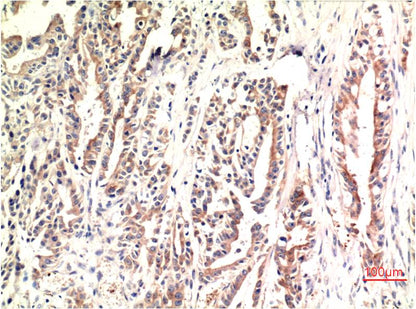 Immunohistochemical analysis of paraffin-embedded Human Stomach Carcinoma Tissue using CHOP (EM1317) Mouse mAb diluted at 1:200.