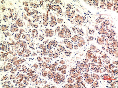 Immunohistochemical analysis of paraffin-embedded Human Pancreas Carcinoma Tissue using CHOP (EM1317) Mouse mAb diluted at 1:200.