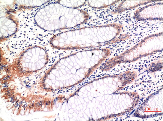 Immunohistochemical analysis of paraffin-embedded Human Colon Carcinoma Tissue using Phospho-MLKL S358 (EM1320) Mouse mAb diluted at 1:200.