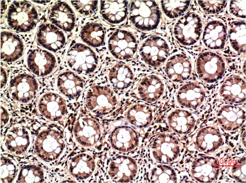 Immunohistochemical analysis of paraffin-embedded Human Colon Carcinoma Tissue using ERK1/2 (EM1326) Mouse mAb diluted at 1:200.