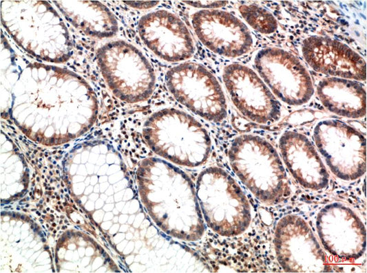 Immunohistochemical analysis of paraffin-embedded Human Colon Carcinoma Tissue using ATM (EM1331) Mouse mAb diluted at 1:200.