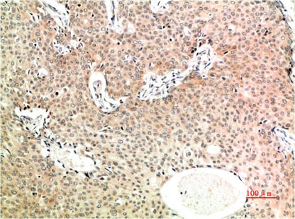 Immunohistochemical analysis of paraffin-embedded Human Breast Carcinoma Tissue using TGFBeta1  (EM1334) Mouse mAb diluted at 1:200.