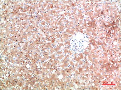 Immunohistochemical analysis of paraffin-embedded Human Liver Carcinoma Tissue using TTR (EM1356) Mouse mAb diluted at 1:200.