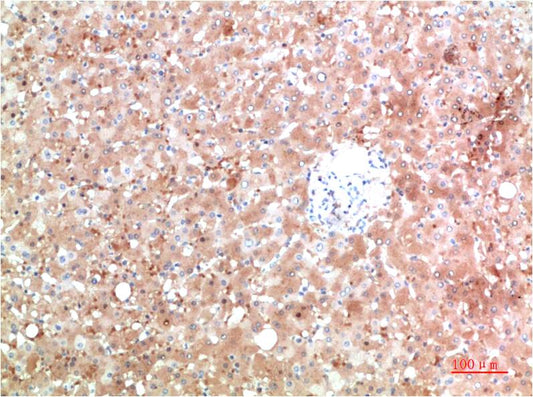Immunohistochemical analysis of paraffin-embedded Human Liver Carcinoma Tissue using TTR (EM1356) Mouse mAb diluted at 1:200.