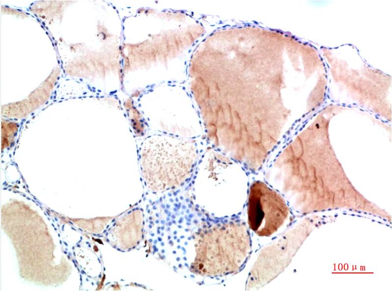 Immunohistochemical analysis of paraffin-embedded Human Thyroid Tissue using TTR (EM1356) Mouse mAb diluted at 1:200.