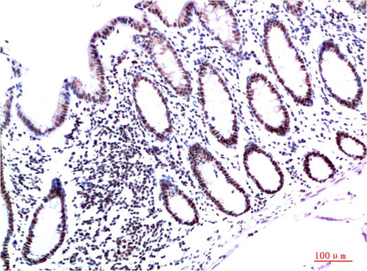 Immunohistochemical analysis of paraffin-embedded Human Colon Carcinoma Tissue using HP-1Gamma  (EM1364) Mouse mAb diluted at 1:200.