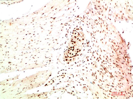 Immunohistochemical analysis of paraffin-embedded Human Colon Carcinoma Tissue using HP-1Alpha (EM1366) Mouse mAb diluted at 1:200.