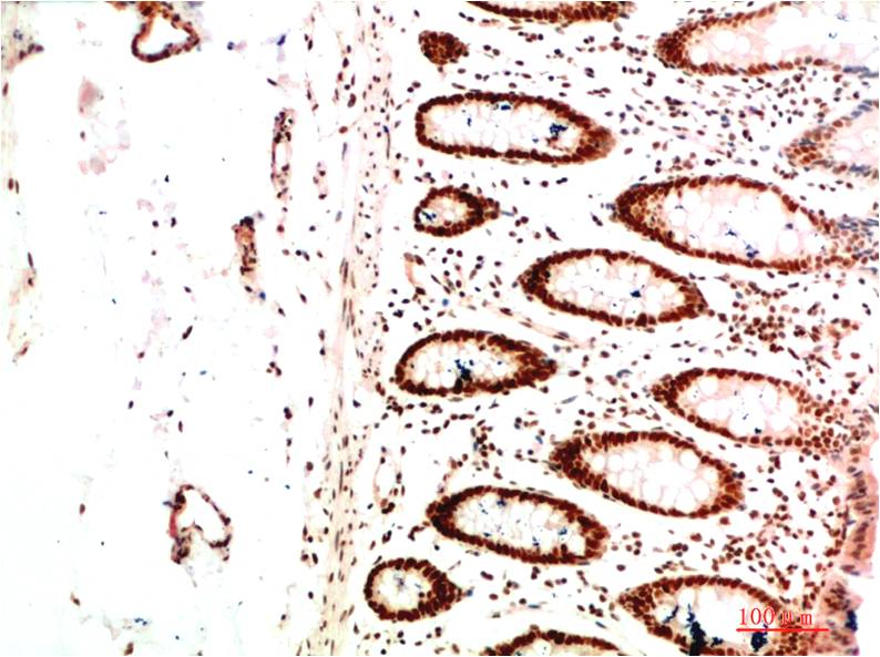 Immunohistochemical analysis of paraffin-embedded Human Colon Carcinoma Tissue using HP-1Alpha  (EM1366) Mouse mAb diluted at 1:200.