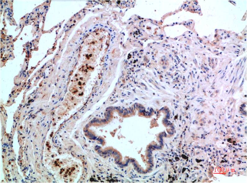 Immunohistochemical analysis of paraffin-embedded Human Lung Carcinoma Tissue using P38  (EM1369) Mouse mAb diluted at 1:200.