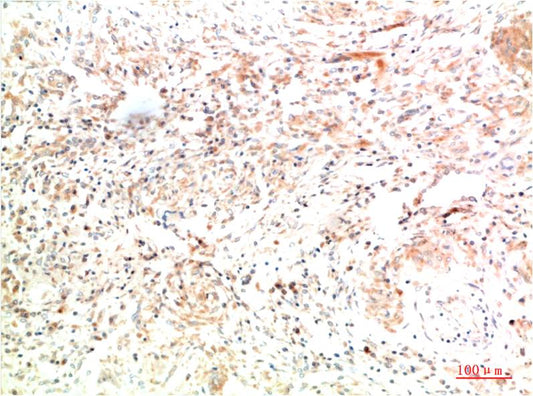 Immunohistochemical analysis of paraffin-embedded Human Lung Carcinoma Tissue using Collagen II  (EM1372) Mouse mAb diluted at 1:200.