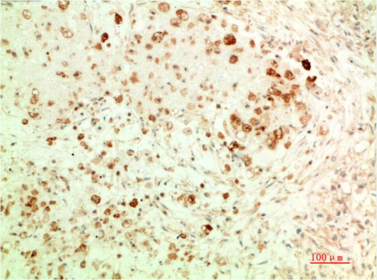Immunohistochemical analysis of paraffin-embedded Human Ovarian Carcinoma Tissue using ATG5  (EM1374) Mouse mAb diluted at 1:200.