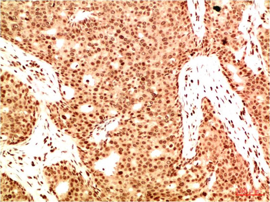 Immunohistochemical analysis of paraffin-embedded Human Breast Carcinoma Tissue using Acetyl NF kB P65(K314/K315)  (EM1377) Mouse mAb diluted at 1:200.