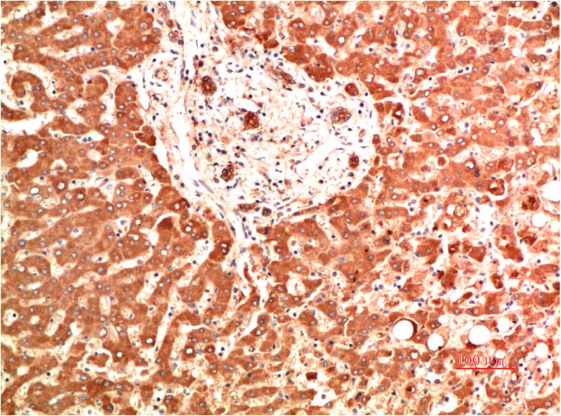 Immunohistochemical analysis of paraffin-embedded Human Liver Carcinoma Tissue using Collagen IV  (EM1393) Mouse mAb diluted at 1:200.