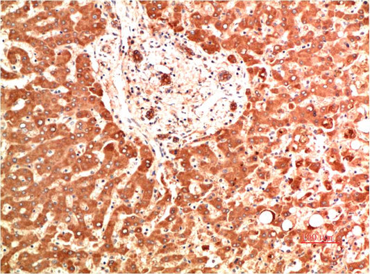 Immunohistochemical analysis of paraffin-embedded Human Liver Carcinoma Tissue using Collagen IV  (EM1393) Mouse mAb diluted at 1:200.
