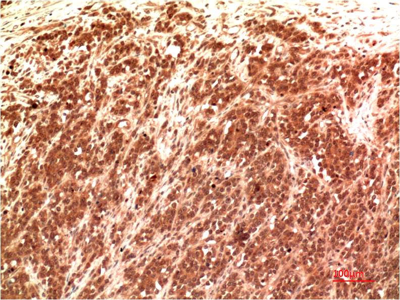 Immunohistochemical analysis of paraffin-embedded Human Kidney Carcinoma Tissue using Claudin-2  (EM1403) Mouse mAb diluted at 1:200.